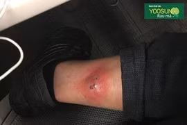 Da hoại tử vì nhện cắn