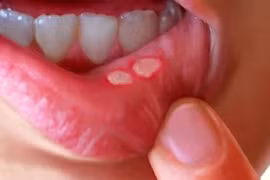  Trị chứng trong miệng lở loét