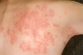 Viêm da cơ địa khó điều trị dứt điểm