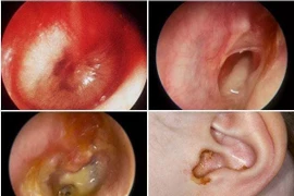 Không tự điều trị viêm tai giữa