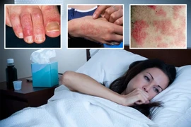 Phát ban, cước mùa đông cẩn thận nhiễm COVID-19 Omicron