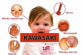 Tiến triển bệnh Kawasaki