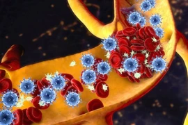 Hoại tử xương: Nguyên nhân và cách điều trị