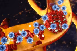 Hoại tử xương: Nguyên nhân và cách điều trị