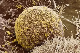 Nhờ phương pháp cấy ghép liên quan đến Bệnh nhân HIV thứ 3 được chữa khỏi nhờ cấy ghép máu dây rốn.