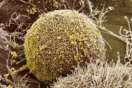 Nhờ phương pháp cấy ghép liên quan đến Bệnh nhân HIV thứ 3 được chữa khỏi nhờ cấy ghép máu dây rốn.