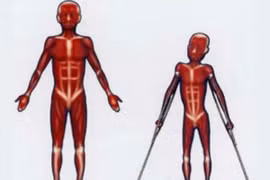 Loạn dưỡng cơ - bệnh di truyền liên kết với giới tính lặn 