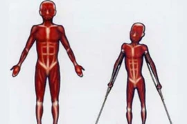 Loạn dưỡng cơ - bệnh di truyền liên kết với giới tính lặn 