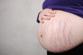 Rạn da có ảnh hưởng tới thai nhi?