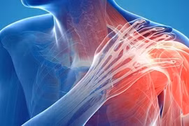 Đau vai và gân lắng đọng canxi