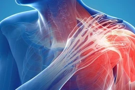 Đau vai và gân lắng đọng canxi