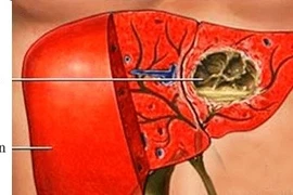  Biến chứng của bệnh áp xe gan do amip