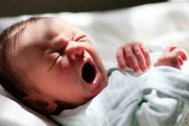 Trẻ sinh non mắc hội chứng Patau