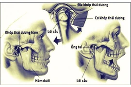  Đau hàm và thái dương khi há miệng