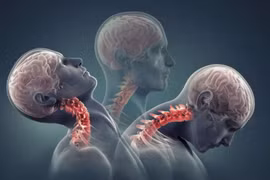 Xử trí ban đầu với chấn thương cột sống cổ