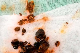 Sỏi ống mật chủ dễ xơ gan, ứ mật