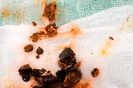 Sỏi ống mật chủ dễ xơ gan, ứ mật