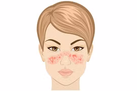 Lupus ban đỏ: Nguyên nhân, triệu chứng và cách cải thiện
