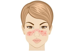 Lupus ban đỏ: Nguyên nhân, triệu chứng và cách cải thiện
