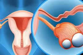 Kinh nghiệm chữa u nang buồng trứng tại nhà an toàn, hiệu quả