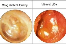 Tự chữa viêm họng dẫn đến viêm tai giữa