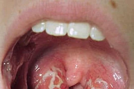 Biến chứng viêm amidan nguy hiểm tính mạng