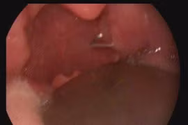 Đinh ghim trong họng bé gái 2 tuổi