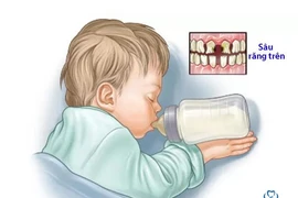 Phá hủy thân răng vì bú bình khi ngủ