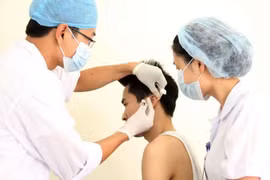 Cấy chỉ  trên loa tai: Công nghệ vi cấy ghép của Việt Nam