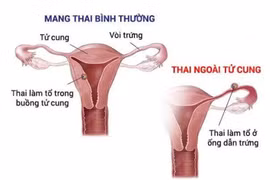  Các yếu tố nguy cơ của thai ngoài tử cung