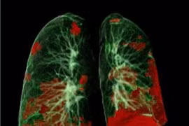 Bác sĩ lo ngại tổn thương phổi hậu Covid 