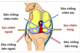 Thời điểm phẫu thuật đứt dây chằng chéo trước