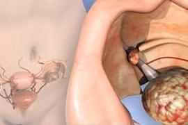 Người có nguy cơ cao mắc ung thư buồng trứng