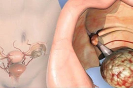 Người có nguy cơ cao mắc ung thư buồng trứng