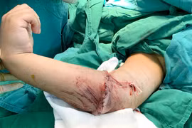 Mổ vi phẫu nối cẳng tay đứt lìa cho bệnh nhân 8 tuổi 