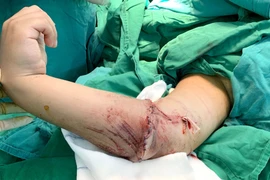 Mổ vi phẫu nối cẳng tay đứt lìa cho bệnh nhân 8 tuổi 