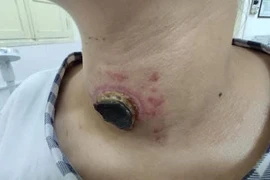 Suy giáp do đắp thuốc