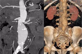 Can thiệp đặt stent Graft động mạch chủ bụng