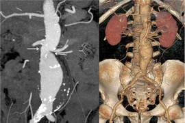 Can thiệp đặt stent Graft động mạch chủ bụng