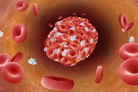 Biến chứng nguy hiểm hậu Covid-19- chứng đông máu