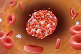 Biến chứng nguy hiểm hậu Covid-19- chứng đông máu