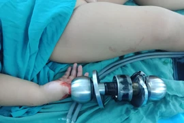 Bé trai 3 tuổi bị kẹt tay trong ổ khóa 