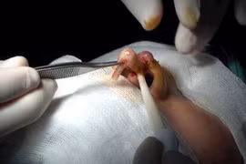 Suýt đứt lìa trụ mũi vì thẩm mỹ “dạo”