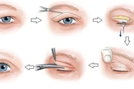 Phẫu thuật da mi thừa