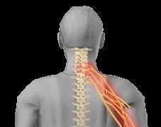  Cơn đau của hội chứng rễ tủy cổ do thoát vị đĩa đệm
