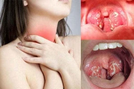 3 bài thuốc chữa viêm amidan hốc mủ có thể bạn chưa biết
