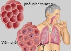 Điều trị bệnh phổi tắc nghẽn mạn tính bằng Đông y