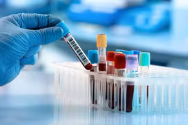 Đổ bệnh vì sợ kết quả tầm soát ung thư 