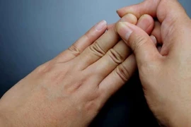 Sưng khớp nhỏ bàn tay