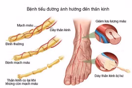 Teo, liệt do bệnh lý thần kinh ở người ĐTĐ